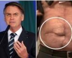 Terminada cirurgia de Bolsonaro, hospital emite nota.