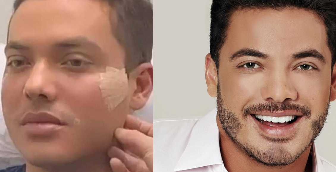 Wesley Safadão aparece irreconhecível na TV após harmonização facial e internet debocha: “Eduardo Costa”