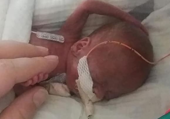 Bebê que nasceu com 340 gramas e 12 cm comemora o primeiro aniversário