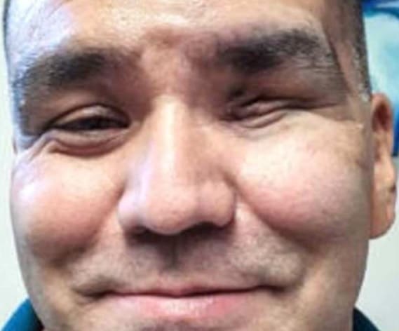 Homem pega fungo negro após ter COVID e perde um olho