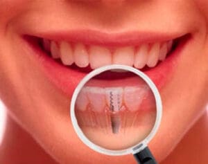 Saiba como realizar seu implante dent&aacute;rio de alta qualidade e com o pre&ccedil;o super em conta