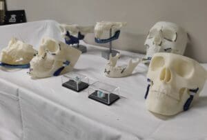 S&atilde;o Jo&atilde;o de Deus recebe pr&oacute;tese para cirurgia de reconstru&ccedil;&atilde;o de mand&iacute;bula