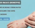 Divin&oacute;polis investiga dois casos suspeitos da var&iacute;ola dos macacos; pacientes est&atilde;o isolados aguardando exames