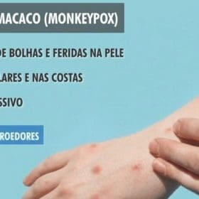 Divin&oacute;polis investiga dois casos suspeitos da var&iacute;ola dos macacos; pacientes est&atilde;o isolados aguardando exames