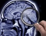 Como surge a doença de Alzheimer?