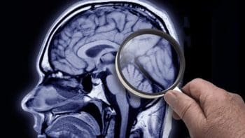 Como surge a doença de Alzheimer?