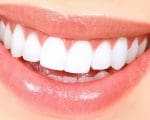 Rápidos resultados colocam o clareamento dos dentes como um dos procedimentos estéticos mais aplicados