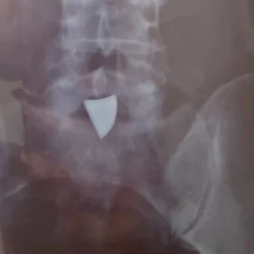 Vítima de assalto aguarda vaga para retirar ponta de faca que ficou em seu corpo