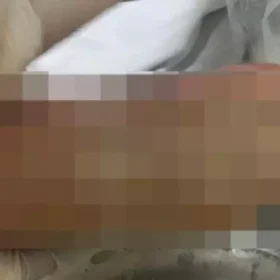 Criança vítima de queimadura em Cmei passa por cirurgia nos pés