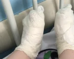 Menina sofreu queimaduras nos pés