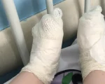 Menina sofreu queimaduras nos p&eacute;s