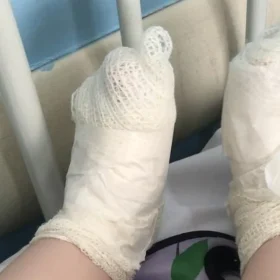 Menina sofreu queimaduras nos pés