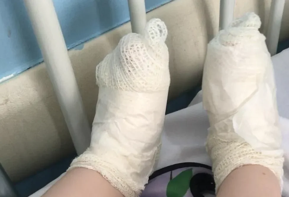 Menina sofreu queimaduras nos pés