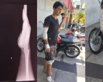 Em Divin&oacute;polis: Jovem precisa de cirurgia urgente, ou poder&aacute; perder os movimentos da m&atilde;o