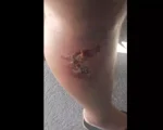 Moradora com perna queimada e inflamada reclama da falta de atendimento no posto de sa&uacute;de do Terra Azul