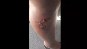 Moradora com perna queimada e inflamada reclama da falta de atendimento no posto de saúde do Terra Azul