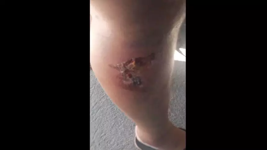 Moradora com perna queimada e inflamada reclama da falta de atendimento no posto de sa&uacute;de do Terra Azul