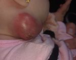 Bebê com furúnculo gera polêmica na UPA Divinópolis