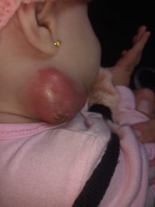 Bebê com furúnculo gera polêmica na UPA Divinópolis