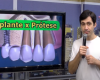 Implante ou prótese? Essa é a dúvida mais comum do paciente na hora de substituir um dente