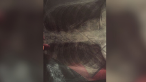 Homem aguarda há cinco meses cirurgia de hérnia na UPA