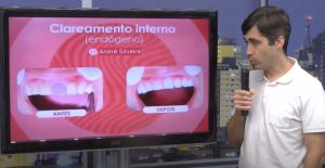 Entrevista: Veja os benef&iacute;cios e quando o clareamento interno &eacute; indicado