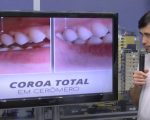 Quadro especial responde sobre coroas dentárias, para que servem e quando são indicadas?