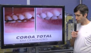 Quadro especial responde sobre coroas dent&aacute;rias, para que servem e quando s&atilde;o indicadas?