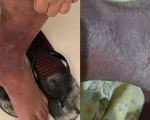 Moradora de Divinópolis pede ajuda para cirurgia de insuficiência venosa crônica
