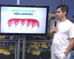 Lesões cervicais não cariosas qual a causa e como tratar