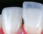 O que fazer quando a restauração dentária escurece? Veja a reposta