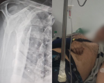 Morador de Divinópolis espera há mais de 30 dias por cirurgia após acidente de moto