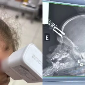 Divinópolis: menina que teve carregador de celular cravado na testa se recupera em casa