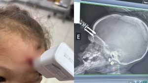 Divinópolis: menina que teve carregador de celular cravado na testa se recupera em casa