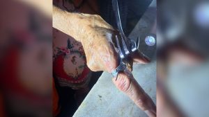 Mulher tenta retirar anel preso com aux&iacute;lio de garfo e &eacute; atendida pelos Bombeiros em Formiga