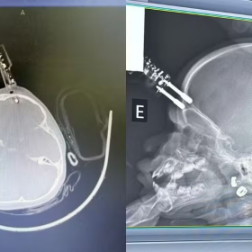 Imagens fortes: Criança passa por cirurgia após ficar com carregador cravado na testa em Divinópolis