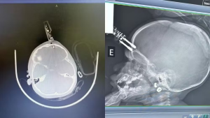 Imagens fortes: Crian&ccedil;a passa por cirurgia ap&oacute;s ficar com carregador cravado na testa em Divin&oacute;polis