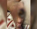 VÍDEO: Idoso internado na UPA em Divinópolis sofre com dedo do pé necrosando e aguarda vaga para tratamento