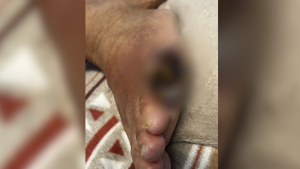 V&Iacute;DEO: Idoso internado na UPA em Divin&oacute;polis sofre com dedo do p&eacute; necrosando e aguarda vaga para tratamento