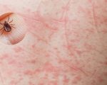 FEBRE MACULOSA: PONTOS IMPORTANTES PARA PREVENÇÃO