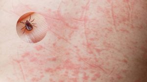 FEBRE MACULOSA: PONTOS IMPORTANTES PARA PREVEN&Ccedil;&Atilde;O
