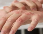 Anvisa amplia uso de medicamentos para crian&ccedil;as com l&uacute;pus e esclerose m&uacute;ltipla