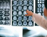 Terapia genética reduz convulsões em crianças com epilepsia rara