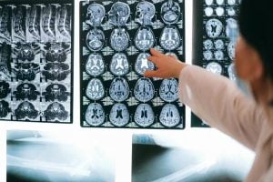 Terapia genética reduz convulsões em crianças com epilepsia rara
