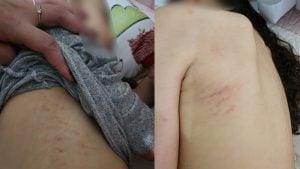 Família denuncia ferimentos em criança autista de escola de educação especial em Divinópolis