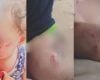Mãe faz BO contra escola após filha ser mordida por colega em Divinópolis: 'Não pode ser normal'