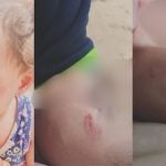 M&atilde;e faz BO contra escola ap&oacute;s filha ser mordida por colega em Divin&oacute;polis: 'N&atilde;o pode ser normal'