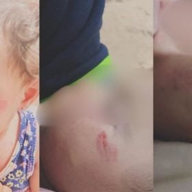 Mãe faz BO contra escola após filha ser mordida por colega em Divinópolis: 'Não pode ser normal'