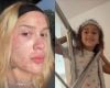 Karoline Lima revela rosto após procedimento estético e filha sugere maquiagem para disfarçar vermelhidão