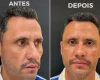 Um dia após ser eleito, Cleitinho faz procedimentos estéticos no rosto